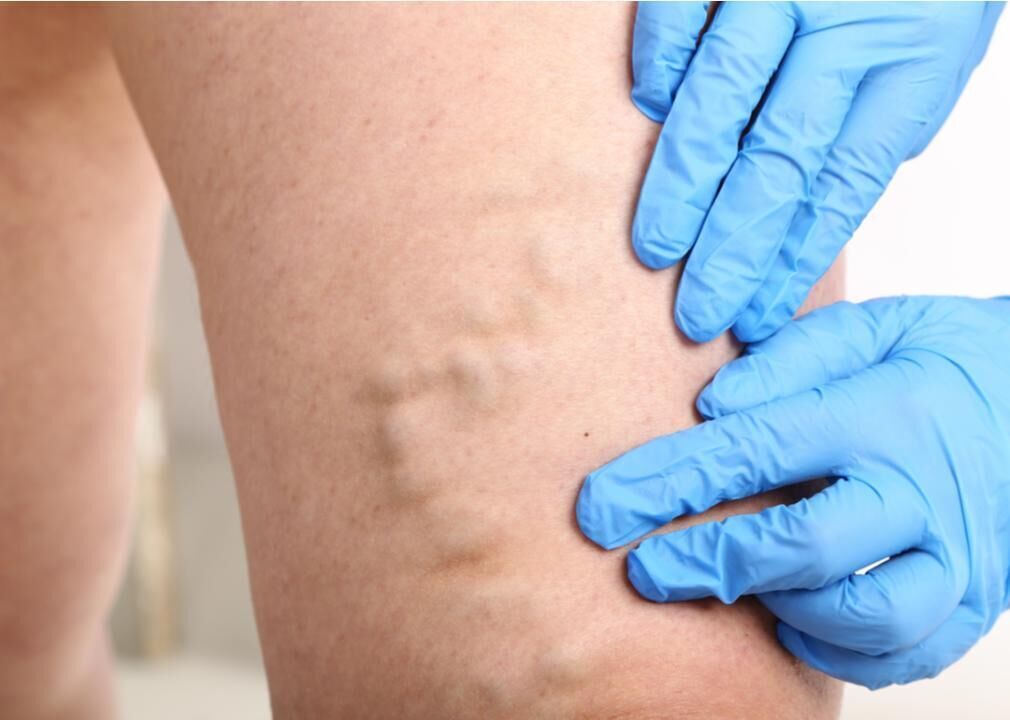 More frequent blood clots